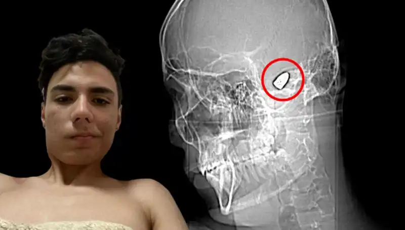 Kafasında Patlayıcı Var: Hayatı Tehlikede Olan Efsane Gelişme