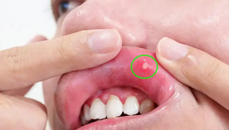 Kanserin Gizli Uyarısı: Dil Alınması Gereken Bir Durum